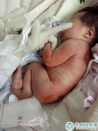 被烫伤的孩子。家属供图