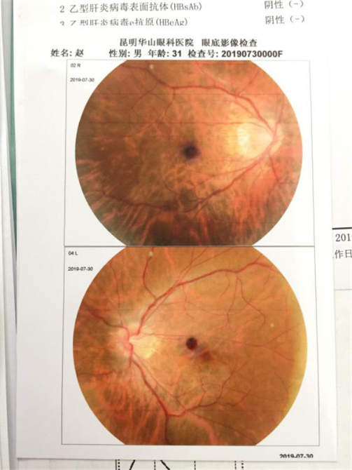医生通过检查发现赵先生双眼眼底都已呈现豹纹状
