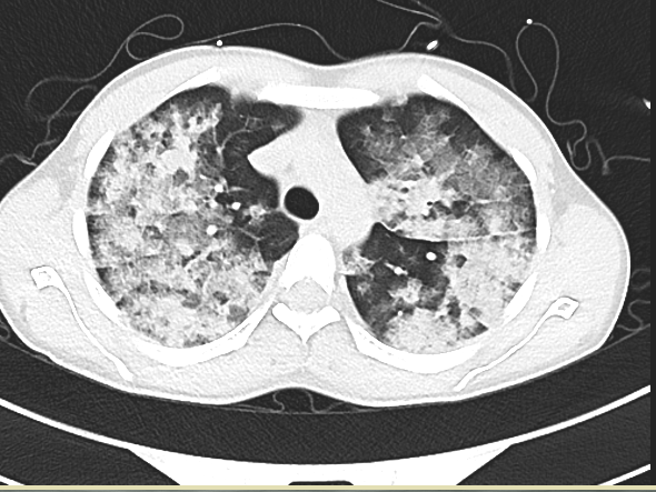 出现高反休息下就好了？当心危及生命！（大理大学第一附属医院供图）